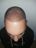 5. 1st day after surgery.jpg