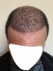 25. Recipient 30 days after surgery.jpg