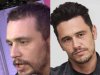 james-franco-hair-transplant-before-and-after.jpg