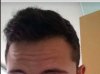 hairloss-5.JPG hairloss-5.JPG