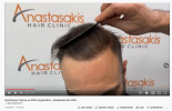 Screenshot 2022-04-08 at 11-15-46 Αποτέλεσμα 12μήνου με 3000 τριχοθυλάκια - Anastasakis Hair C...png