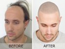 Scalp-Micropigmentation-2.jpg