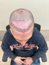 1st Days post op - 1771 Grafts - Top.jpg