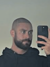 Chris-Bumstead-Hair-Transplant-Before-and-After.png