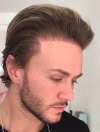 natural-hairline-bad-celebrity-hair-transplant.png.ddcbae4fbd7ec8abbacb7f03b56e7496.png