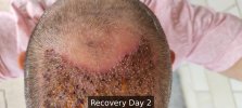 Recovery Day 2 - 1.jpg