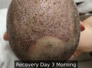 Recovery Day 3 Morning- 0.jpg