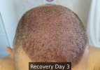 Recovery Day 3 - 1.jpg
