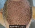 Recovery Day 3 - 3.jpg