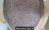 Recovery Day 4 - 1.jpg