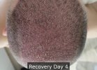 Recovery Day 4 - 2.jpg