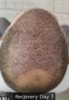 Recovery Day 7 - 1.jpg