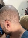 1 week after HT (2).jpg