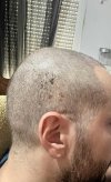 1 week after HT (3).jpg