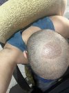 1 week after HT (4).jpg