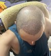 1 week after HT (5).jpg