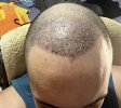 1 week after HT.jpg