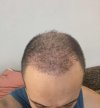 1 month after HS (2).jpg