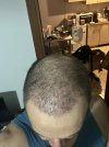 1 month after HS (5).jpg