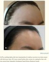 laser treatment.jpg