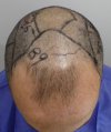 Pre-op 13-1.jpg