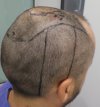 Pre-op 13-3.jpg