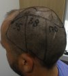 Pre-op 13-4.jpg