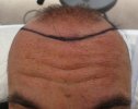 Pre-op σχεδιασμός hairline 1.jpg