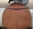 Pre-op σχεδιασμός hairline.jpg