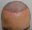 Post-op 1-3 HL.jpg