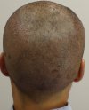 Post-op Day 1 occipital area 1.jpg