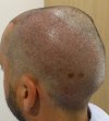 Post-op Day 1 parietal area .jpg
