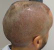 Post-op Day 1 parietal area 1.jpg