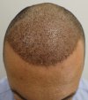 Post-op Day 6 recepient area.jpg