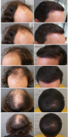 Hair Restoration Before and After Results.png