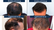 Hair Transplant Progress Montage.png