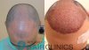 tmp_7826-c-p-fue-hair-transplant-8-1366x768-1072124865.jpg