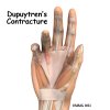 dupuytrens_contracture_new_intro.jpg